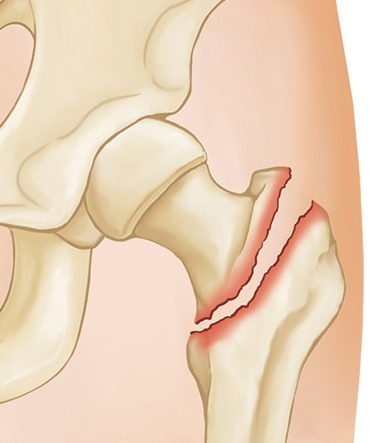Fractura de Cadera - Enfermedad tratada por el Dr. Miguel Angel Barrios Andaluz
